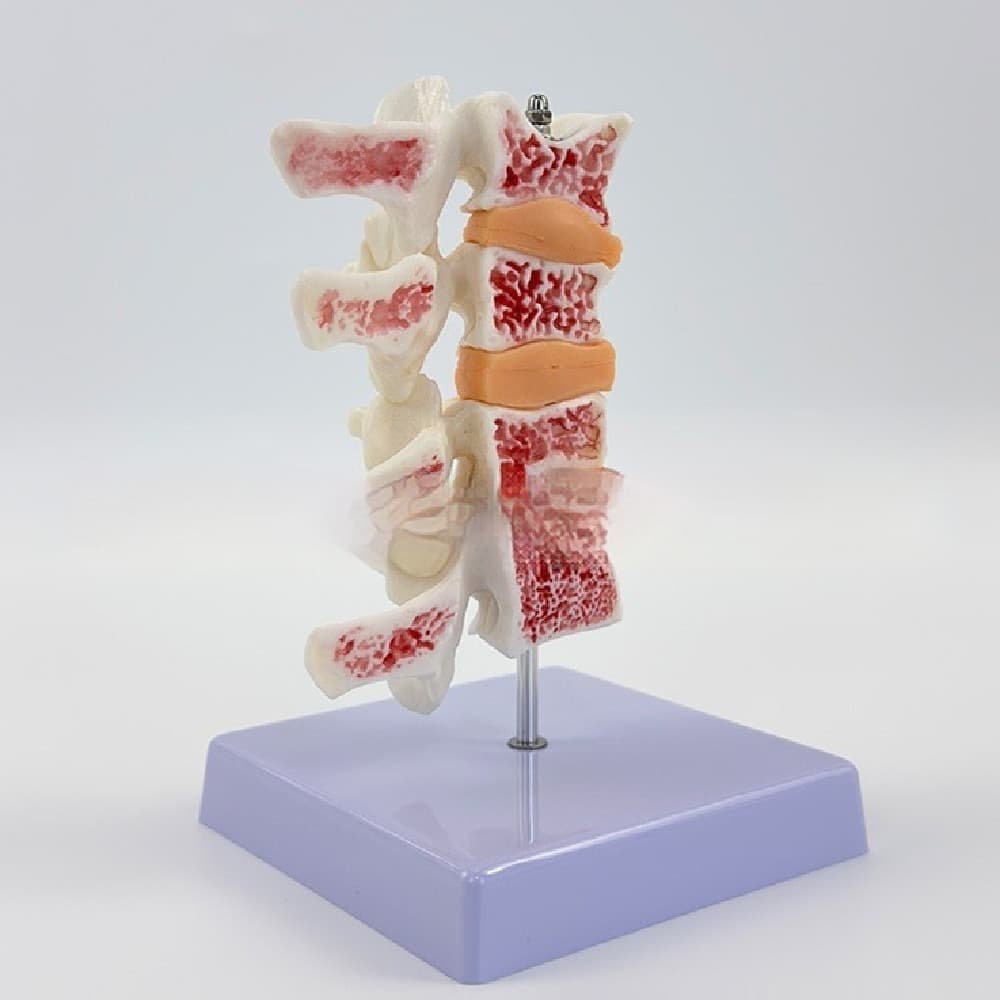 Osteoporosis Human Spine Model Set